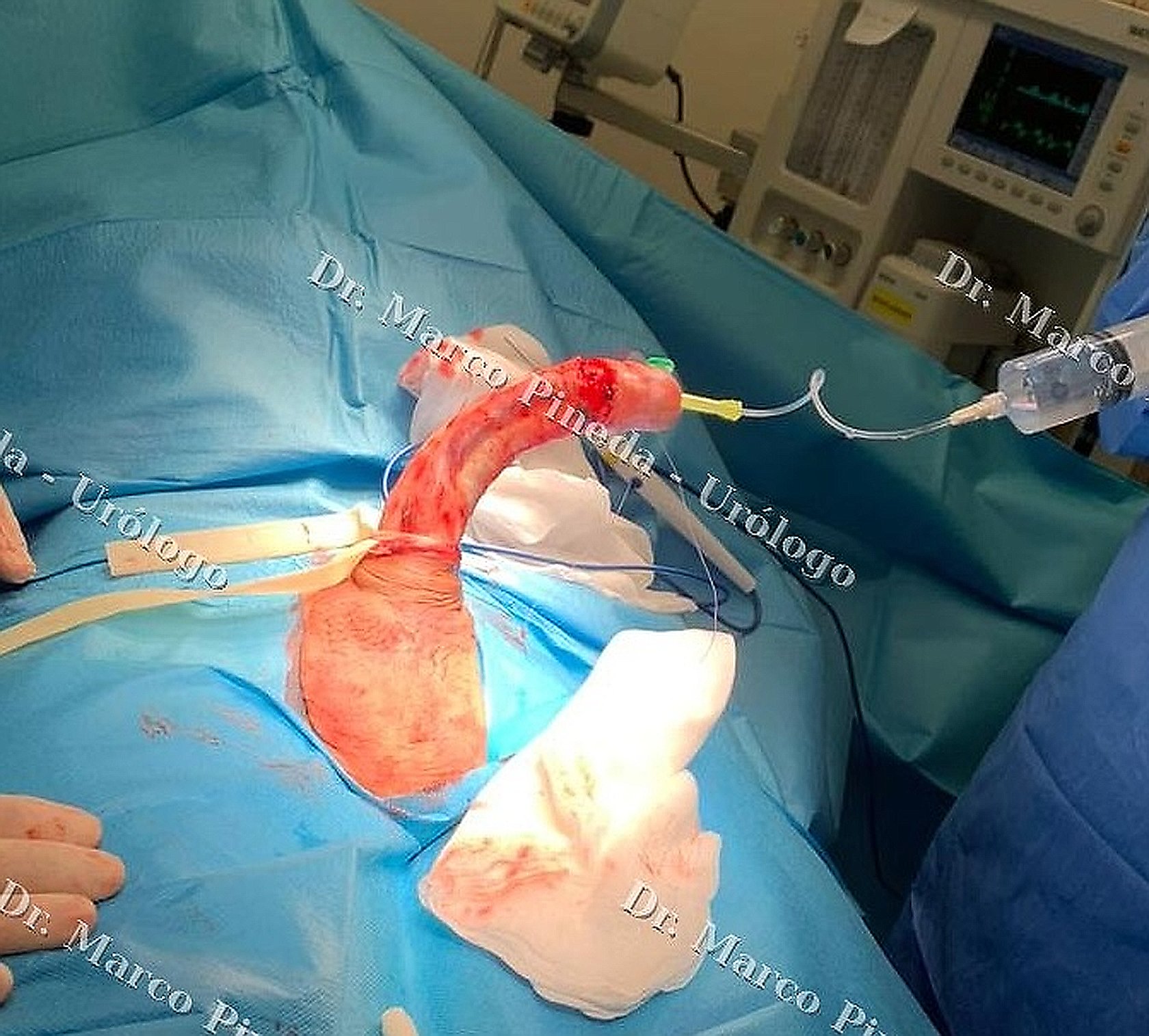 Preoperative severe hourglass deformity with artificial erection test